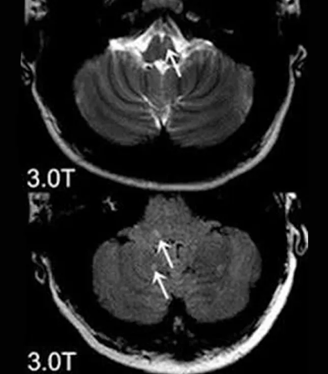 Ảnh MRI Tesla lát cắt thân não