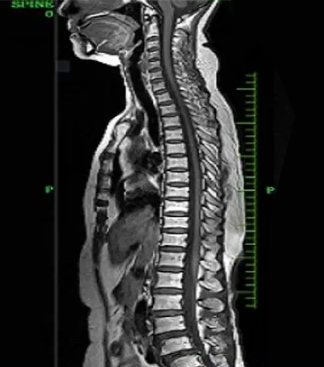 Ảnh MRI cột sống lát cắt dọc