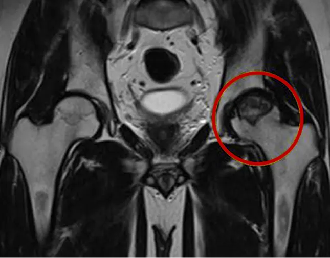 Ảnh MRI khớp háng phát hiện tổn thương