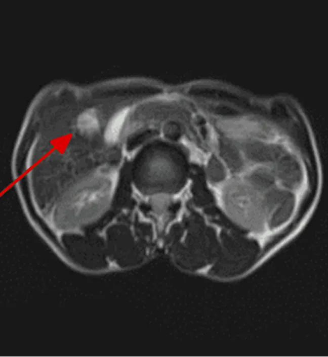 MRI ổ bụng