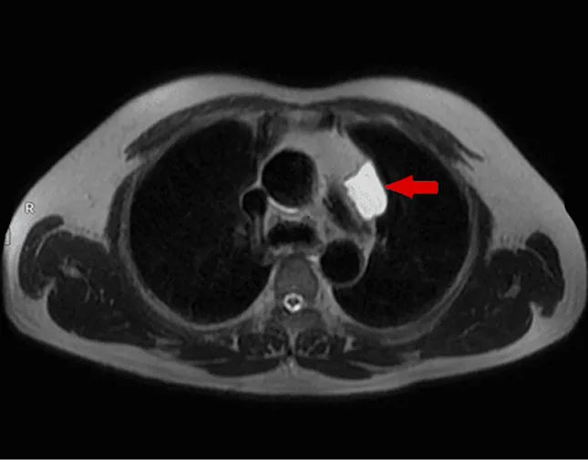 MRI ngực