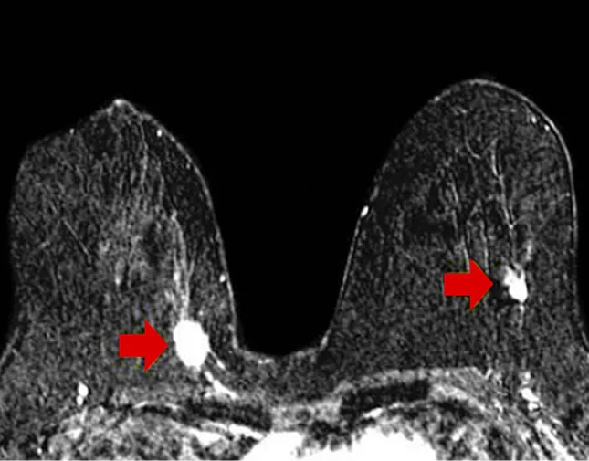Ảnh MRI tuyến vú phát hiện tổn thương