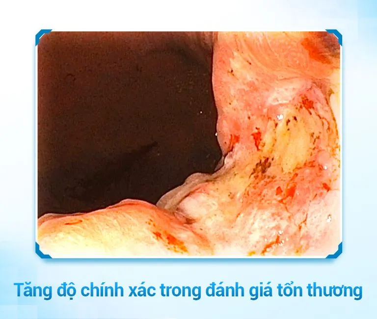 Hình ảnh nội soi tăng độ chính xác khi đánh giá tổn thương