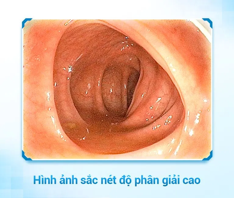 Hình ảnh nội soi đại tràng sắc nét độ phân giải cao