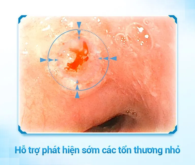 Hình ảnh nội soi hỗ trợ phát hiện sớm các tổn thương nhỏ