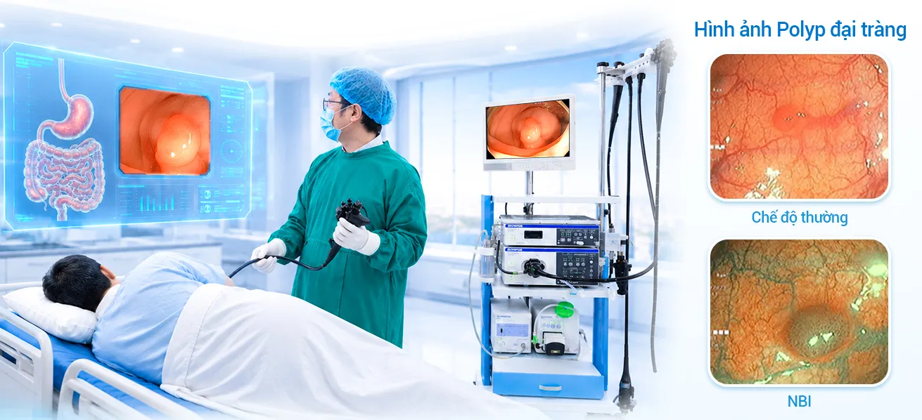 So sánh hình ảnh Polyp đại trường ở chế độ thường và NBI