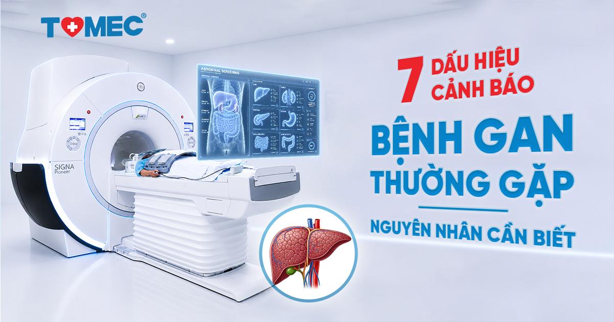 7 dấu hiệu cảnh báo bệnh gan thường gặp và nguyên nhân cần biết